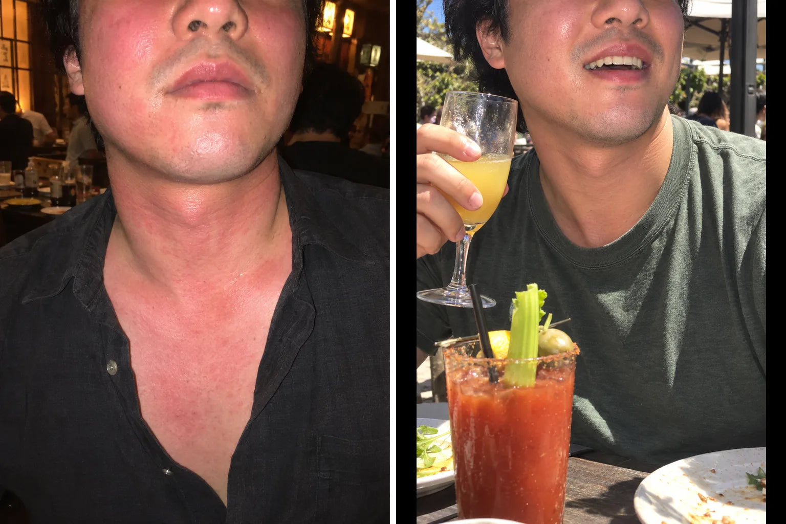Illustration: a red neck and upper chest in an open white shirt on the left, and the same neck and chest with far less red on the right